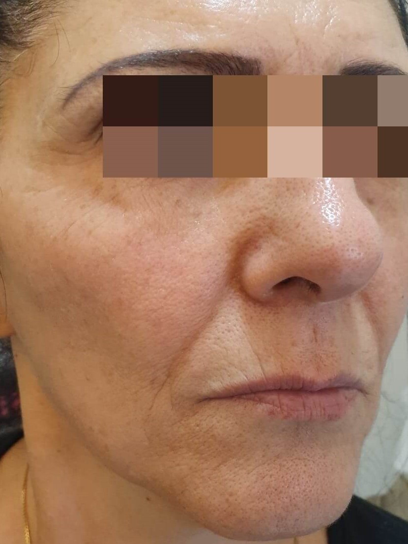 פנים לפני טיפול ב Anti-Aging