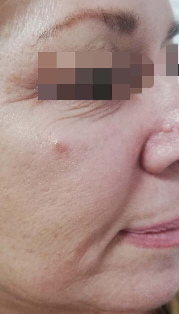 Face before treatment inAnti-Aging