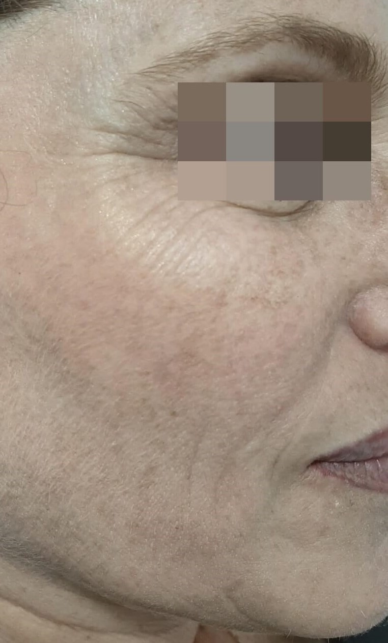 פנים לפני טיפול ב Anti-Aging