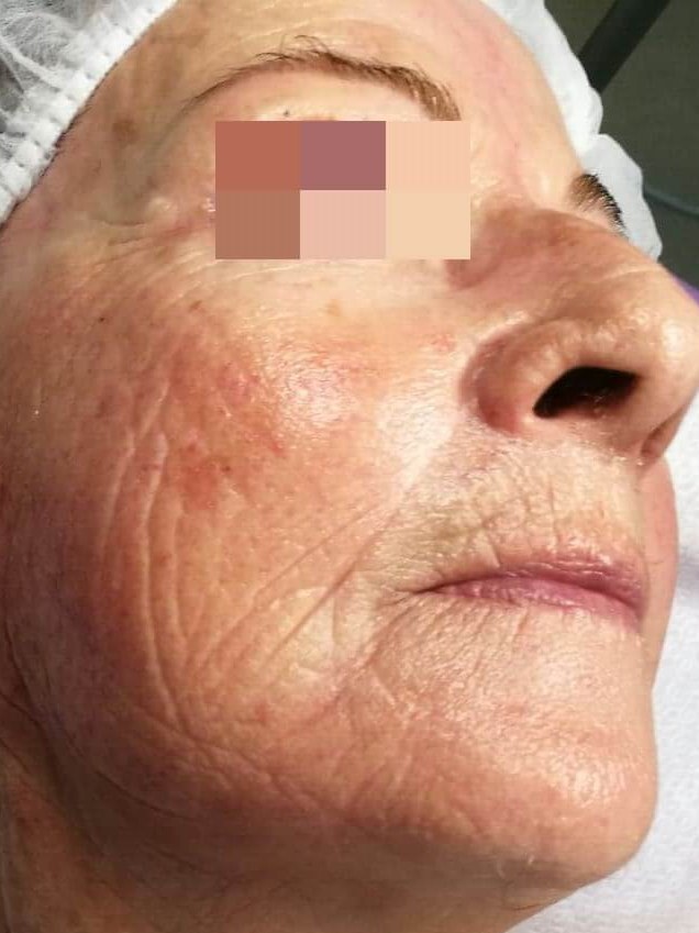 פנים אחרי טיפול ב Anti-Aging