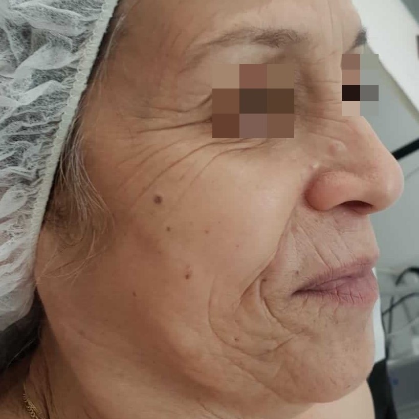 Face before treatment inAnti-Aging