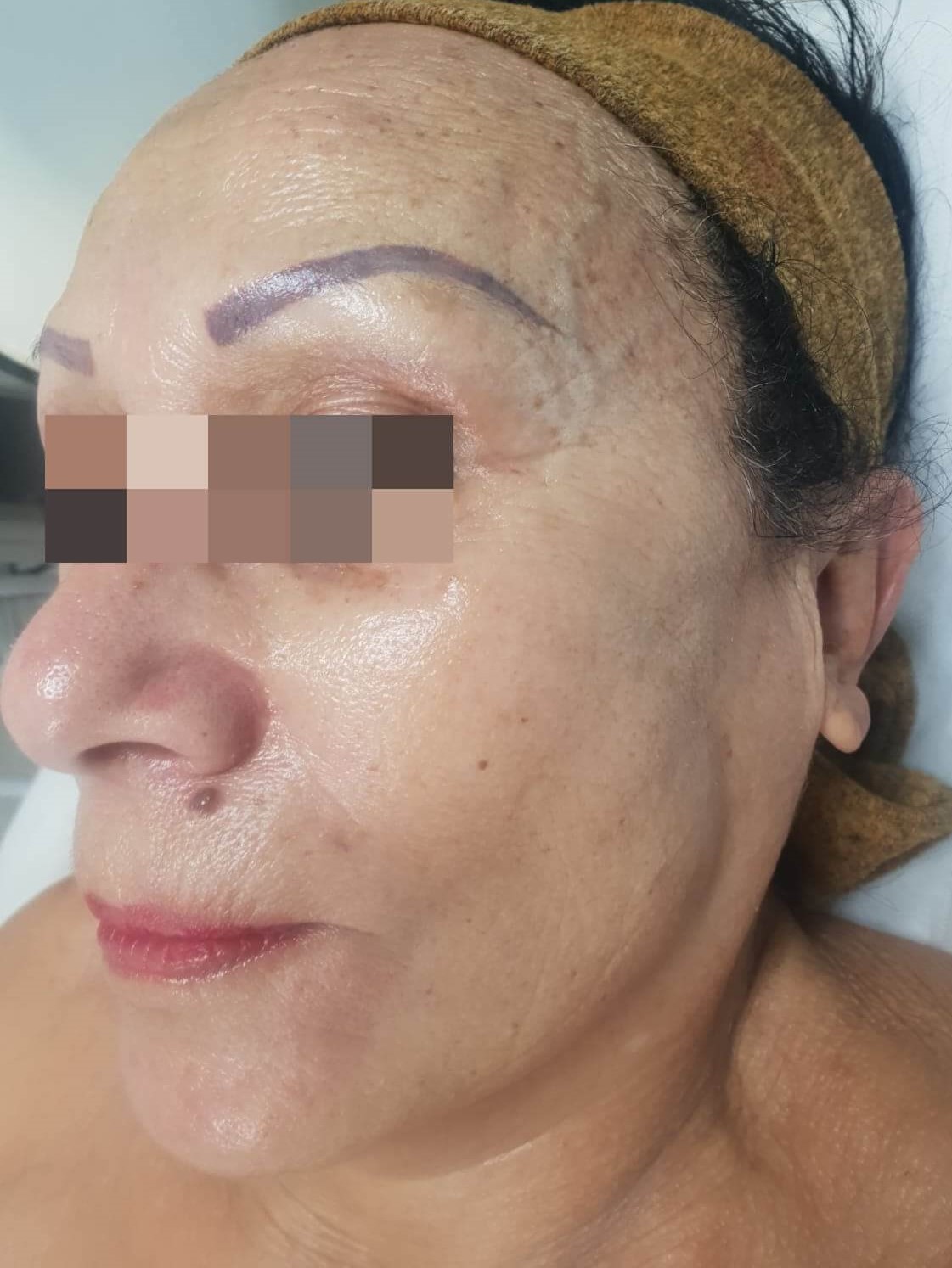 פנים אחרי טיפול ב Anti-Aging