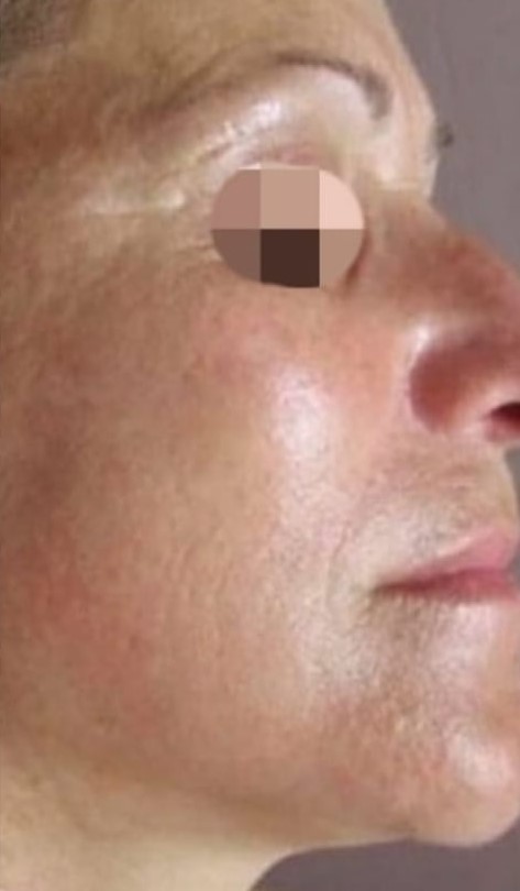Face after treatment inAnti-Aging