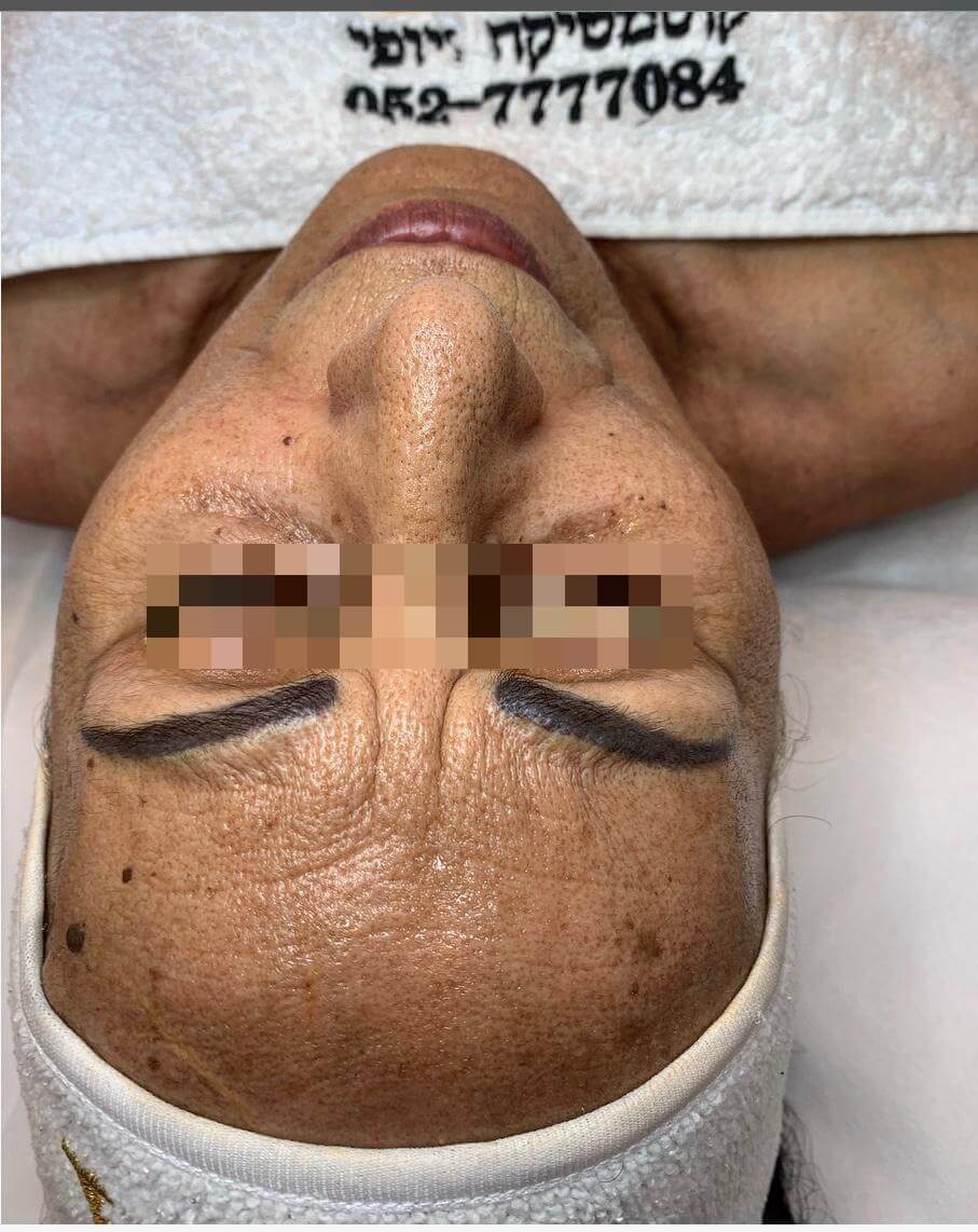 Face before treatment inPigmentation