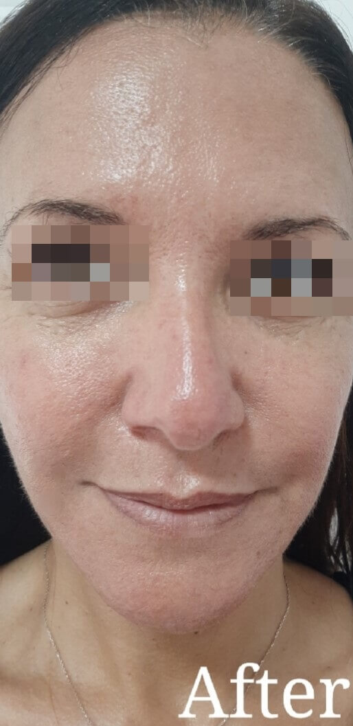 פנים אחרי טיפול ב Pigmentation